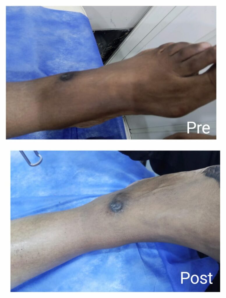 Laser leg lightening and whitening